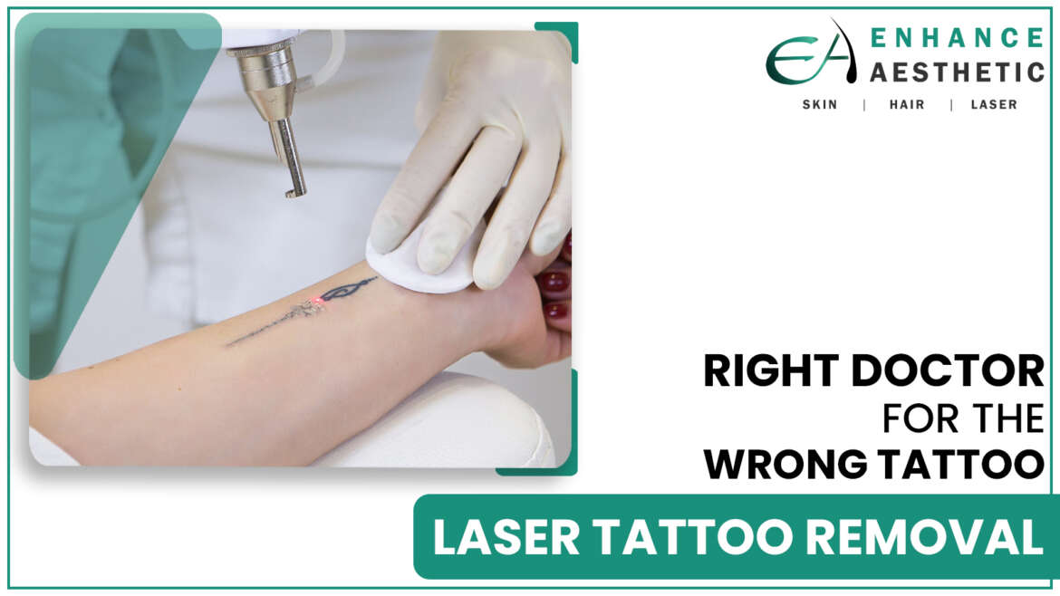 Tattoo removal
