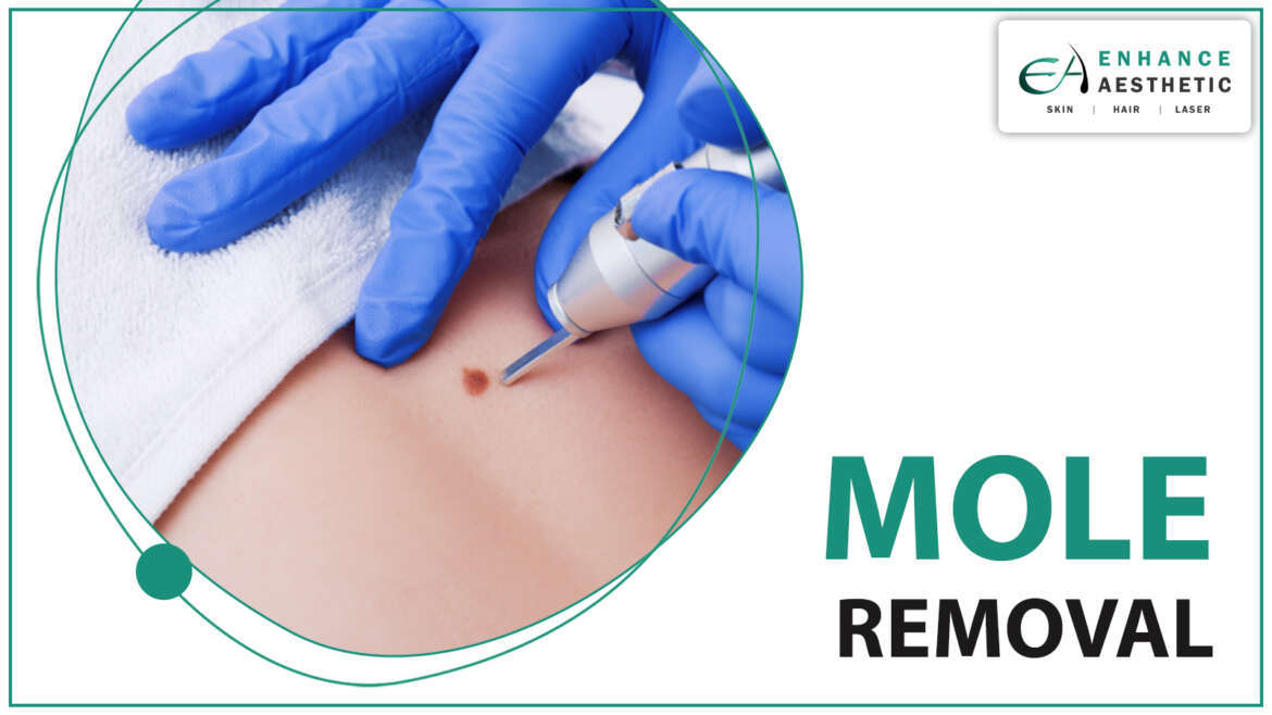 Mole Removal