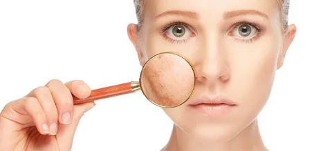 <strong><em>Treating hyperpigmentation and dark spots on the skin</em></strong>