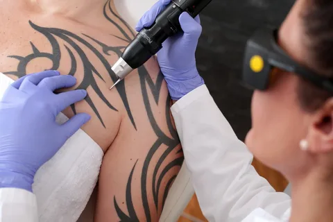 Tattoo Removal Myths Debunked: Separating Fact from Fiction