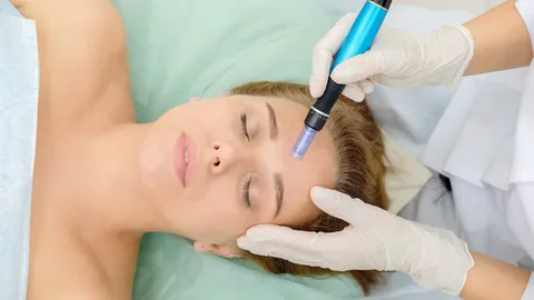 Understanding Micro-Needling: How it Works to Reduce Acne