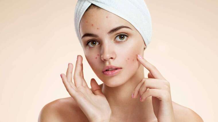 From Acne to Elegance, Conquering Common Skin Concerns
