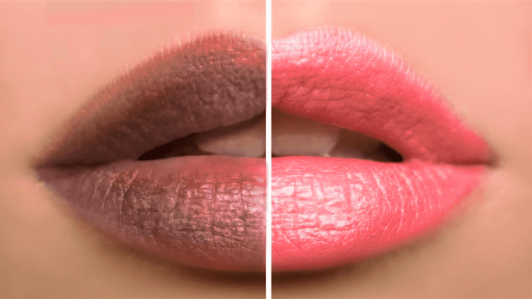 From Causes to Cures: Understanding Dark Lips and Effective Treatment Options
