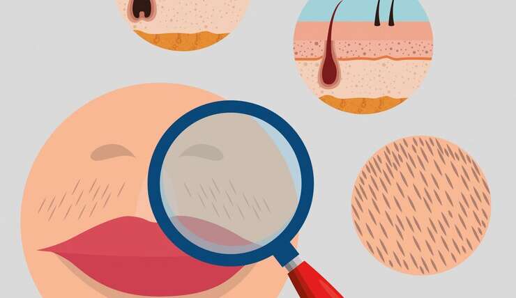 Understanding Hirsutism: Causes And Treatments